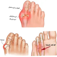درد انگشت پا نشانه یک بیماری جدی است مثل عفونت یا بیماری 