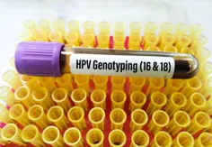 آزمایش HPV چگونه انجام می شود؟