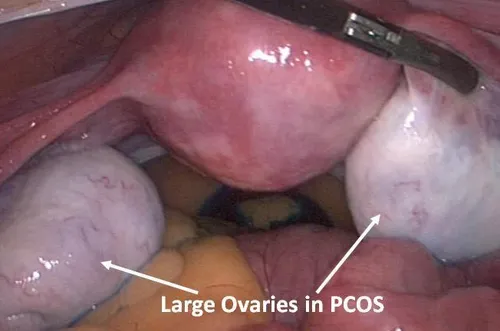 نمایی از تخمدان ها در PCOs