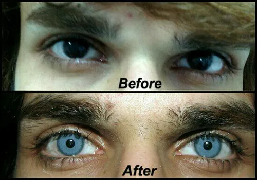 تغییر رنگ چشم با جراحی پلاستیک!