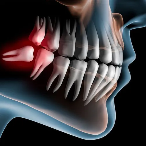 دندان عقل در هر سنی می تواند رشد کند: به عنوان مثال، مورد