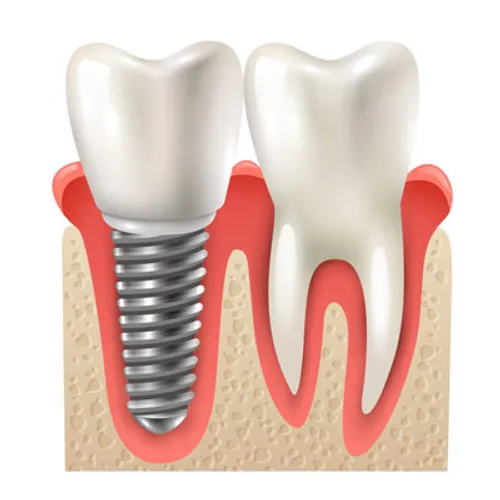 ایمپلنت دندان امروزه بهترین روش برای جایگزینی دندان های ا