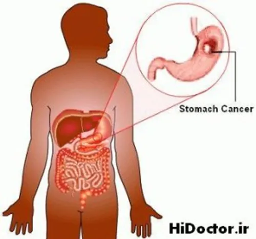 علائم و نشانه های سرطان معده: