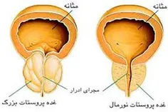 درمان بزرگ‌ شدن  پروستات