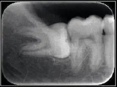 نمایی از یک دندان بی عقل به نام دندان عقل 😝 😂