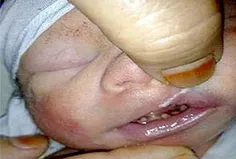 تولد دختره نوزادی با.۳۲ دندان و۲۴ انگشت 