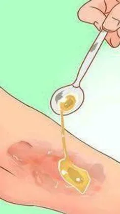 ‍ 🍯  عسل در تسریع ترمیم زخم مؤثر بوده و می‌تواند از باقی 