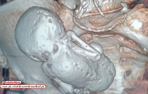 🔺 جنین سنگی 35 ساله در شکم زن الجزایری 😳 😱