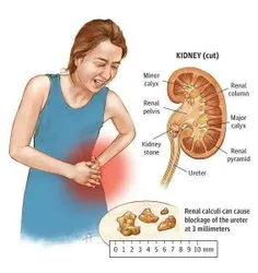 🙆‍♀سنگ کلیه یکی از ناراحت کننده ترین بیماری هاست که معمول