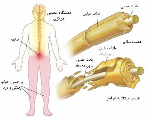 7نشانه خاموش ابتلا به ام اس