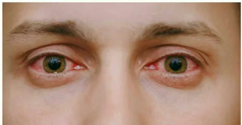قرمزی چشم ها به طور کلی عاملی نگران کننده نیست اما زمانیک