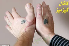 در صورت قطع شدن انگشت شست دست، می‌توان انگشت شست پا را به