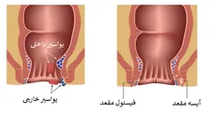 تفاوت آبسه مقعد و بواسیر