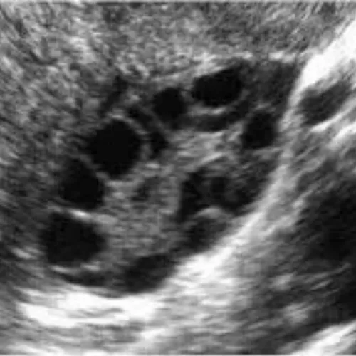 سونوگرافی تخمدان خانمی که مبتلا به سندرم تخمدان پلیکیستیک