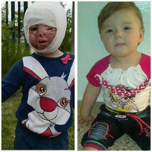شکنجه و سوزاندن صورت کودک معصوم سوری توسط تروریستها در تل