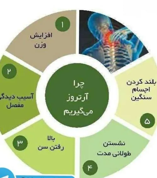 میتوان آرتروز پیشگیری کرد