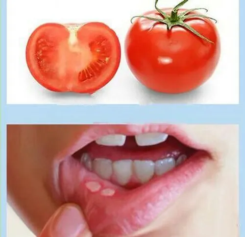 گوجه فرنگی را برای درمان آفت بطور روزانه مصرف کنید.