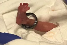 یک نوزاد نارس که در آمریکا متولد شده به قدری کوچک است که 