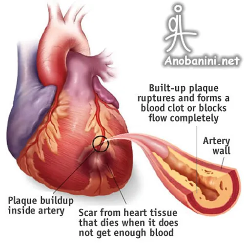 چه کنیم به بیماری تصلب شراین و در پی آن حمله قلبی گرفتار 