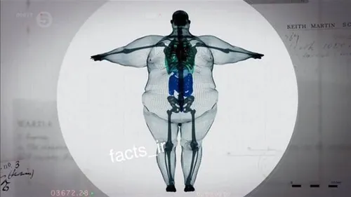 اشعه ایکس از یک مرد 410 کیلو گرمی😱