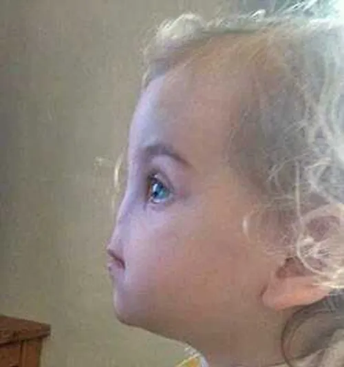 روشی باور نکردنی برای ساخت بینی در دختر 2 ساله متولد شده 