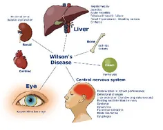 بیماری ویلسون کبد، کلیه، چشم، سیستم مغز و اعصاب و... را د