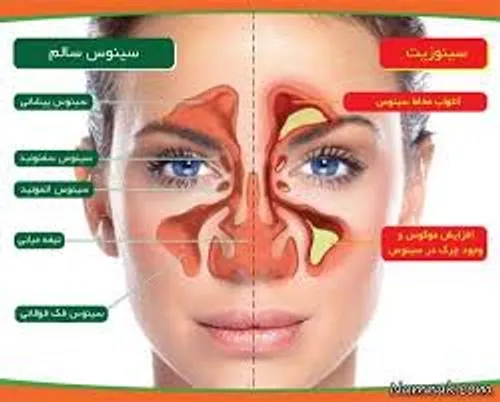 سینوزیت و درد دندان