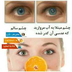 🔺👈عدسی چشم انسان به طور طبیعی دارای مقدار زیادی ویتامین C