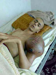 پسری ۲۱ ساله توده سرطانی توی دستش داره اسمش محمد رضاست گو