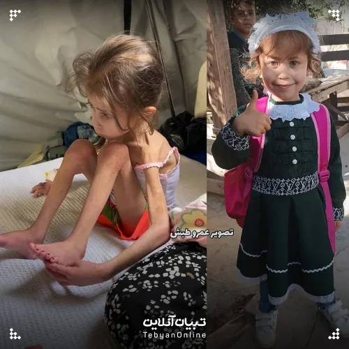 قبل و بعد این دختربچه فلسطینی!
