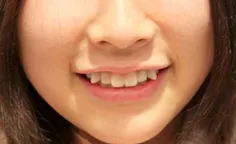 عمل زیبایی دندان نیشی دختران#مد جدید در#ژاپن