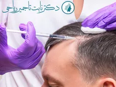 تزریق فیلر مو ( Hair Filler ) توسط دکتر نابت تاجمیر ریاحی