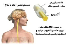 منشا بیماری MS چیست ؟!