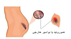 درمان سریع بواسیر خارجی (هموروئید خارجی) بدون جراحی