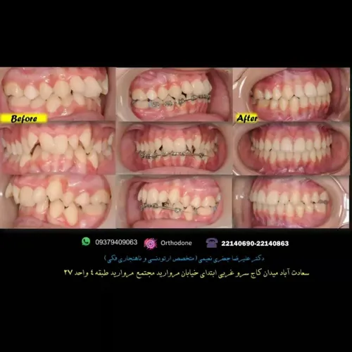 درمان ارتودنسی بدون کشیدن دندان در یک نوجوان 17 ساله (این