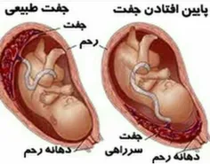 مقایسه شکل بارداری با جفت طبیعی و بارداری با جفت سرراهی👇👇