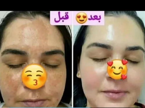 🛑 رضایت مشتری گلم بعد از استفاده از پک کرم ضد لک 😍😍