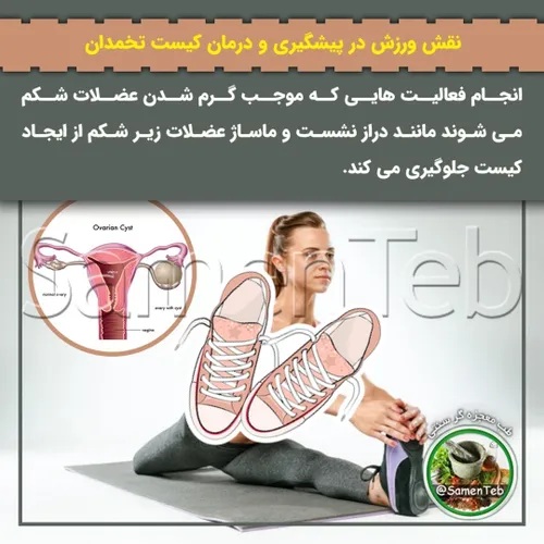 🤸‍♀نقش ورزش در پیشگیری و درمان کیست تخمدان