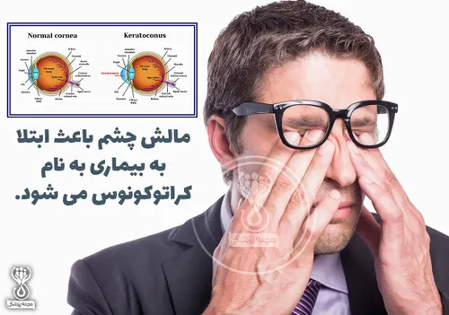 مالش چشم باعث ابتلا به بیماری به نام کراتوکونوس می شود !