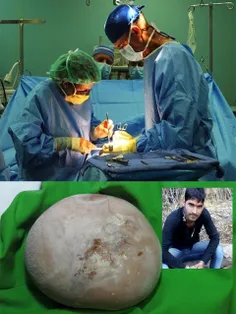 بزرگترین سنگ کلیه خارج شده از بدن انسان متعلق به جوان هند