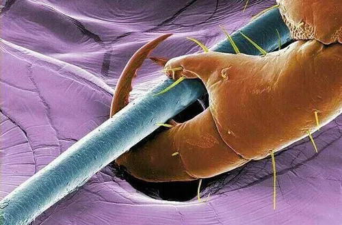 تصویر میکروسکوپیک از یک تار مو در چنگال شپش سر بالغ 🕷 شپش