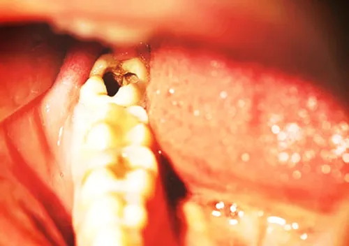 پوسیدگی دندان (به انگلیسی Tooth Decay) از رایج ترین بیمار