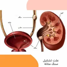 🔻 #سنگ_مثانه و روش دفع آن