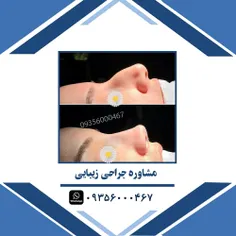 ⚜️ جراحی زیبایی بینی ⚜️