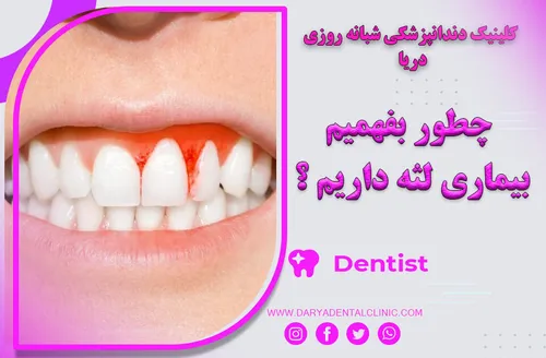 چطوربفهمیم بیماری لثه داریم ؟