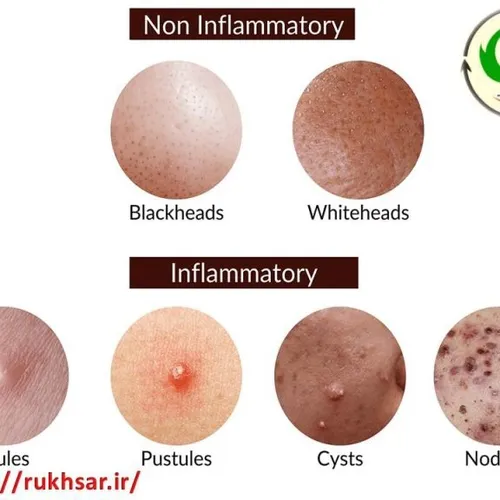 انواع جوش و آکنه