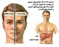 علائم کبد خراب