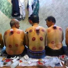 Men at a private health care facility in which Hijama (so