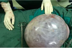 🔴  توده ۱۱ کیلوگرمی در یک عمل جراحی کم‌سابقه در بیمارستان