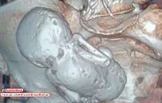 🔺 جنین سنگی 35 ساله در شکم زن الجزایری 😳 😱 